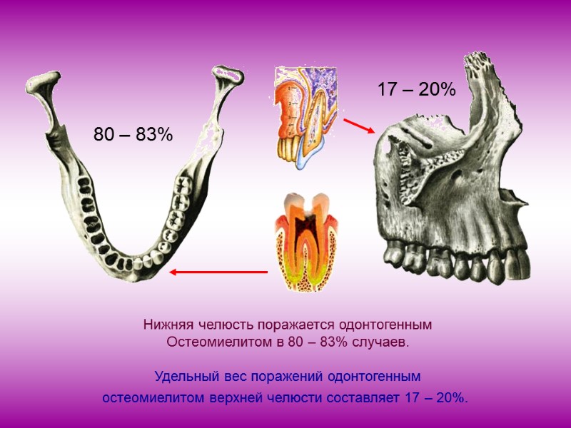 Нижняя челюсть поражается одонтогенным Остеомиелитом в 80 – 83% случаев.  Удельный вес поражений